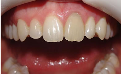 Blanqueamiento dental Rosario