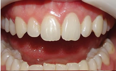 Blanqueamiento dental Rosario
