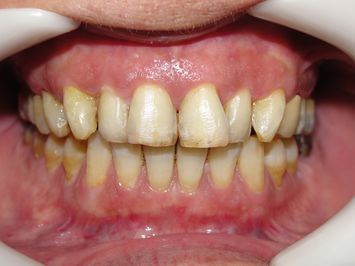 Blanqueamiento dental Rosario después