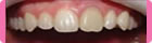 Blanqueamiento Dental