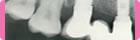 Implantes Dentales