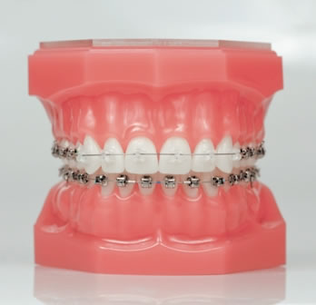 Damon Clear - Ortodoncia Estetica Rosario