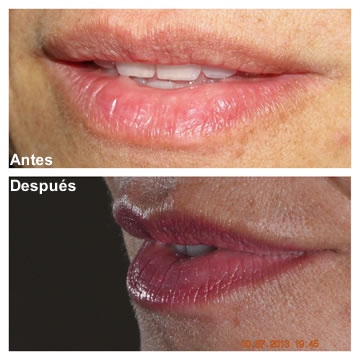 Relleno Labial Rosario