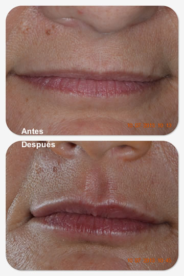 Relleno Labial Rosario